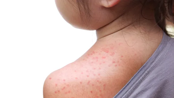 Measles on child