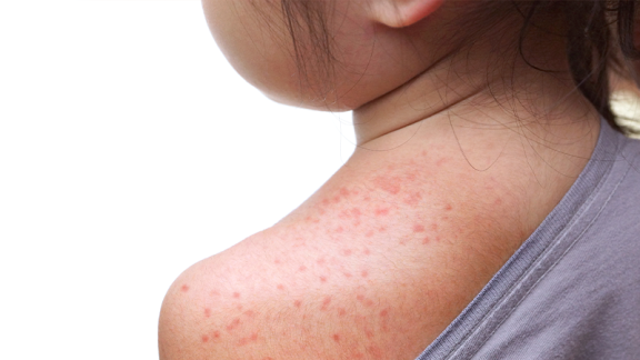 Measles on child