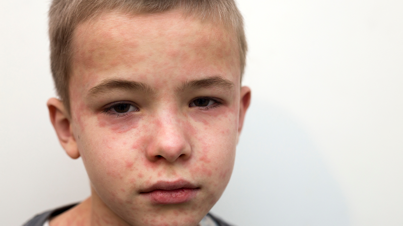 Measles on child