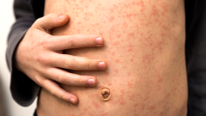 Measles on child