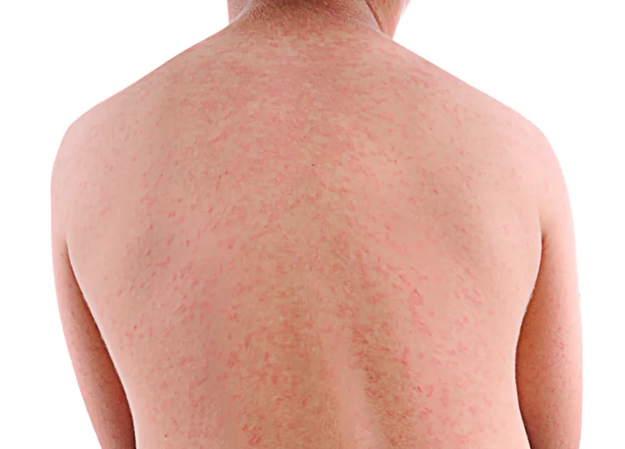 Back with measles rash