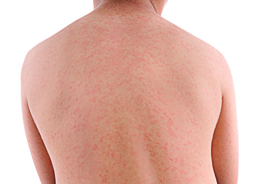 Back with measles rash