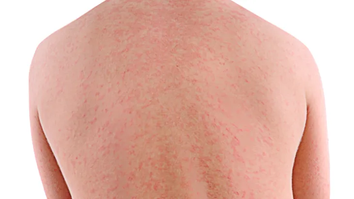 Back with measles rash