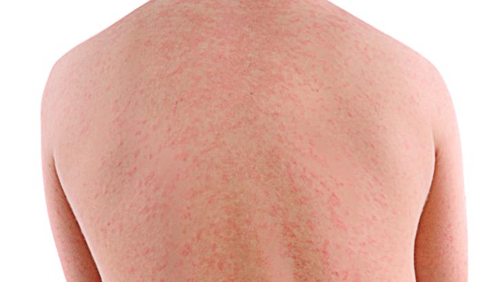 Back with measles rash