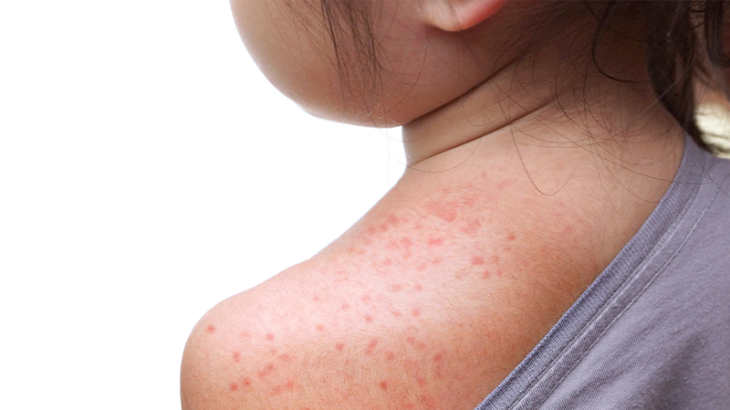 Measles on child